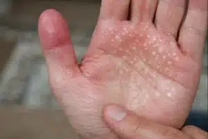 Irritations et micro-lésions visibles sur la paume de la main après port prolongé de gants de protection