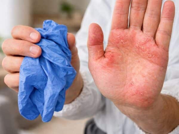 Main présentant des irritations cutanées tenant un gant nitrile retiré après une intervention professionnelle