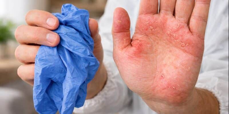 Main présentant des irritations cutanées tenant un gant nitrile retiré après une intervention professionnelle